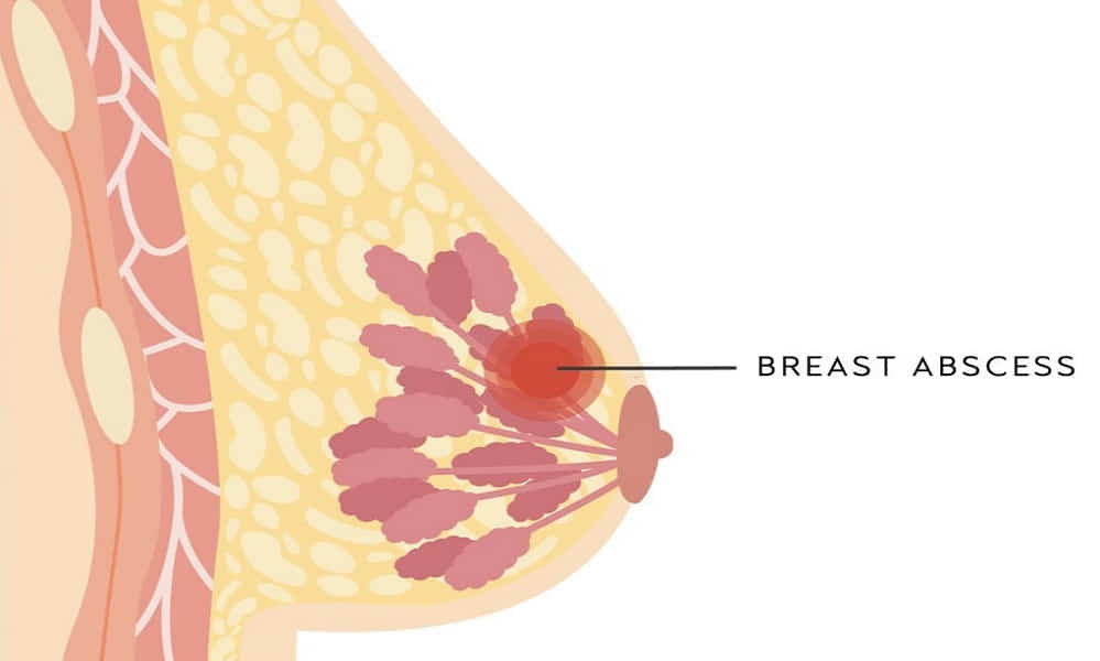 وجود توده های سینه از هفت علت درد سینه در خانم ها