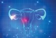درمان تنبلی تخمدان در دختران مجرد