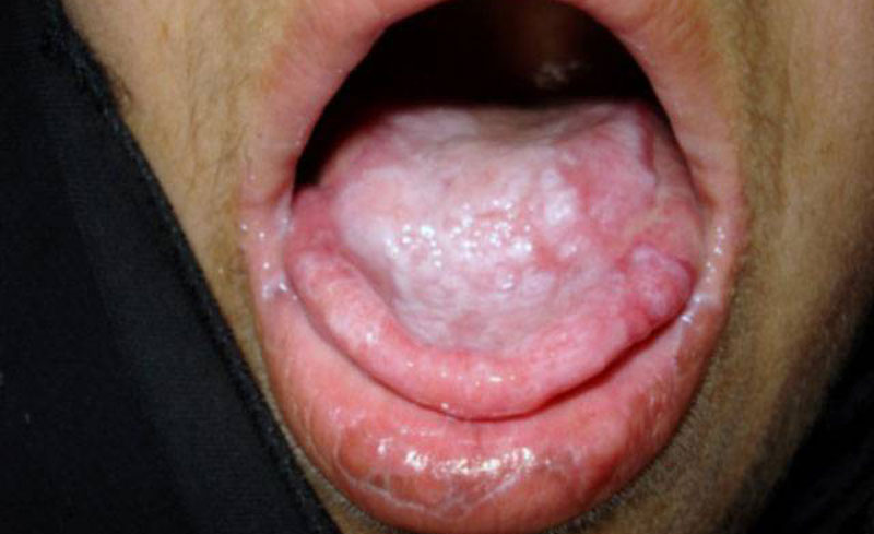 بیماری مقاربتی سفلیس-سکس دهانی
