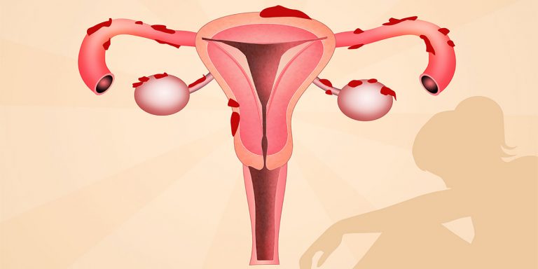 نارسایی زودرس تخمدان چیست؟ + علل بروز آن