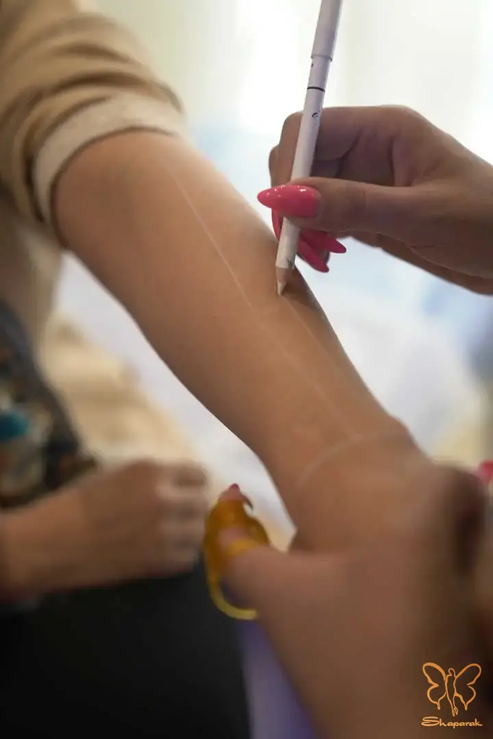 تجربه لیزر مو زائد در وی ای پی ترین کلینیک مشهد